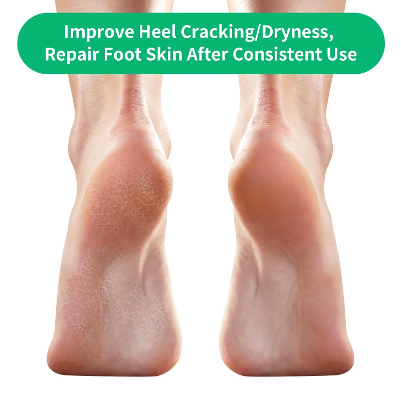 Ohtomber Cracked Heel Treatment Repair Socks - Ohtomber 5 Pairs Silicone Gel Foot Care Softener Toeless Pedicure Moisturizing Dry Feet Socks for Dry Cracked Heels - Image 5